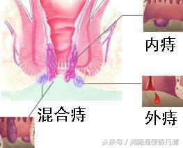 内痔治疗的最新方法与进展